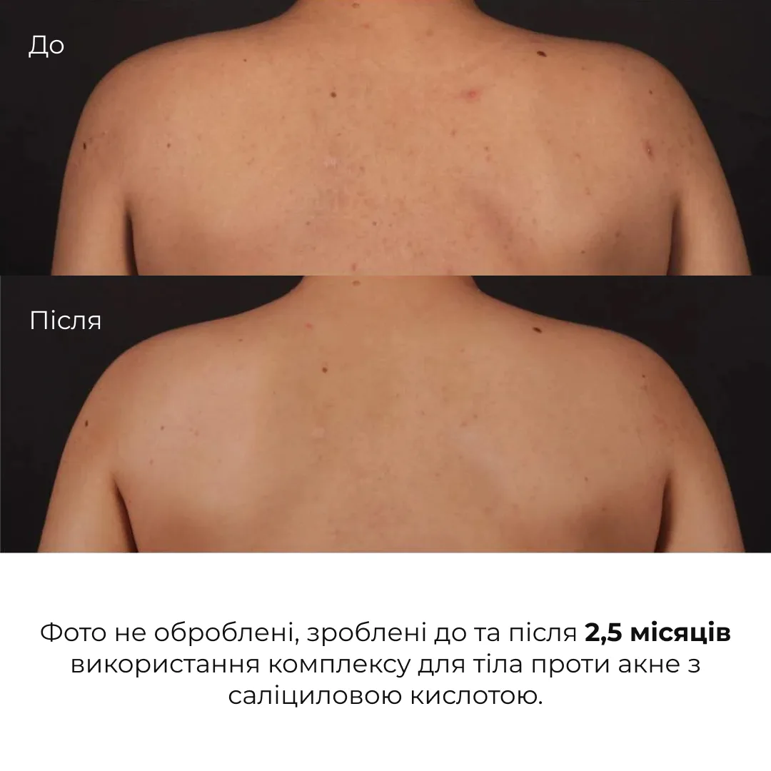 Комплекс проти висипань на тілі та глибокого живлення Hillary Body Acne & Deep Nourishment Complex
