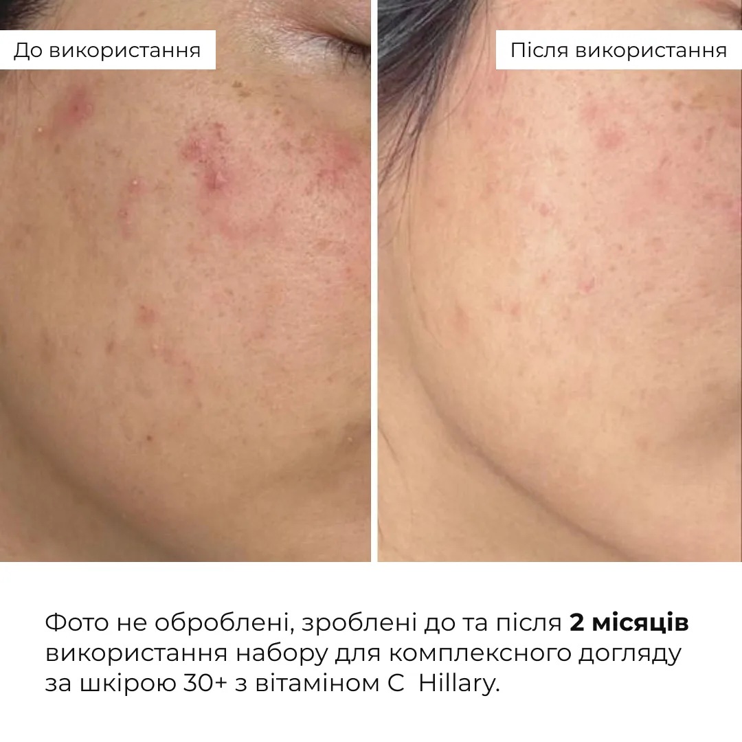 Набор для антивозрастного ухода за кожей 30+ Hillary с витамином С косметический бокс для увлажнения и осветления кожи.