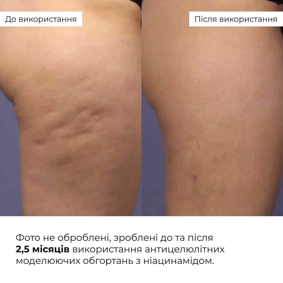 Набір антицелюлітних охолоджувальних обгортань Hillary Cooling Anti-Cellulite Wrap Set