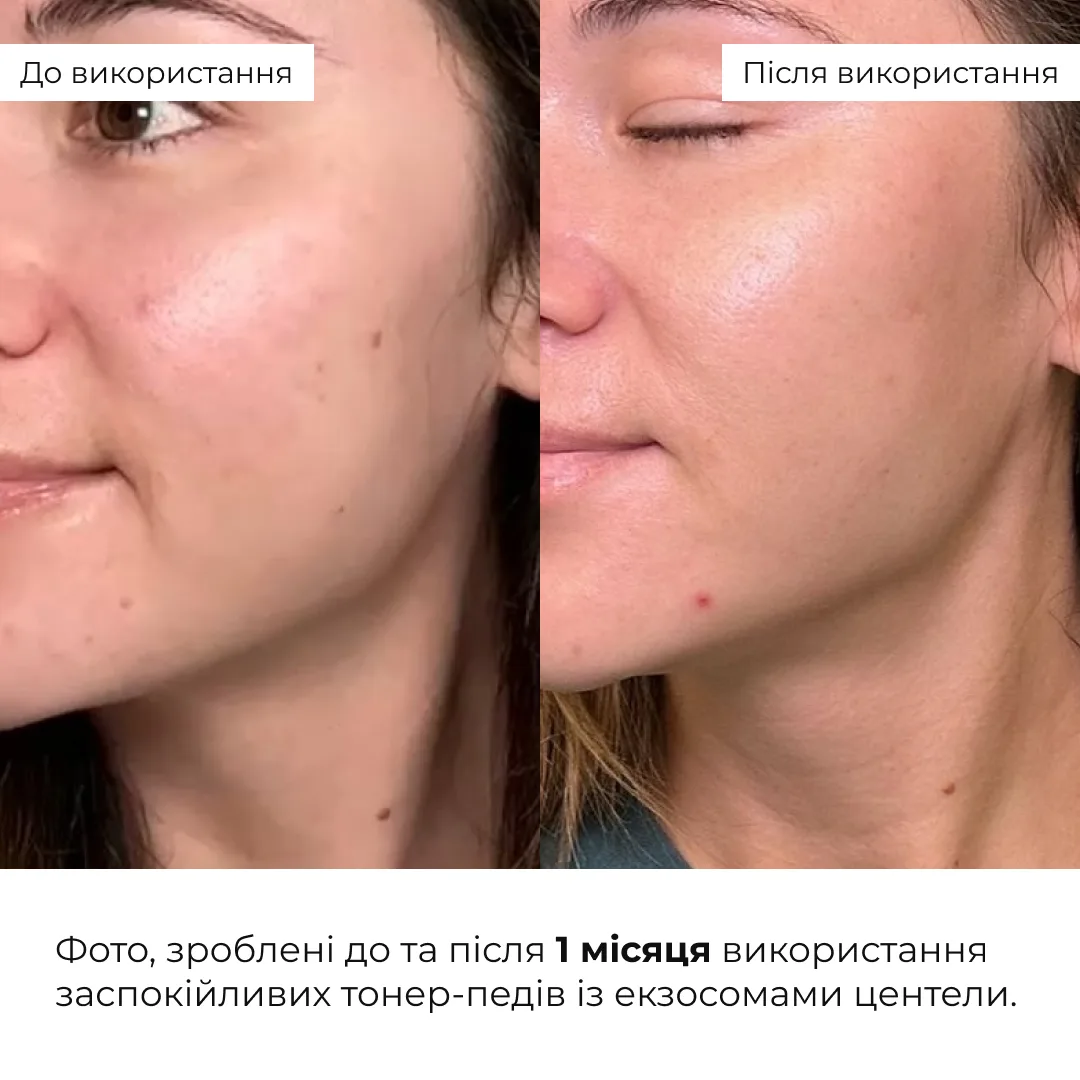 Комплекс з центеллою для заспокоєння та відновлення чутливої шкіри Hillary Centella Calming & Skin Recovery Co