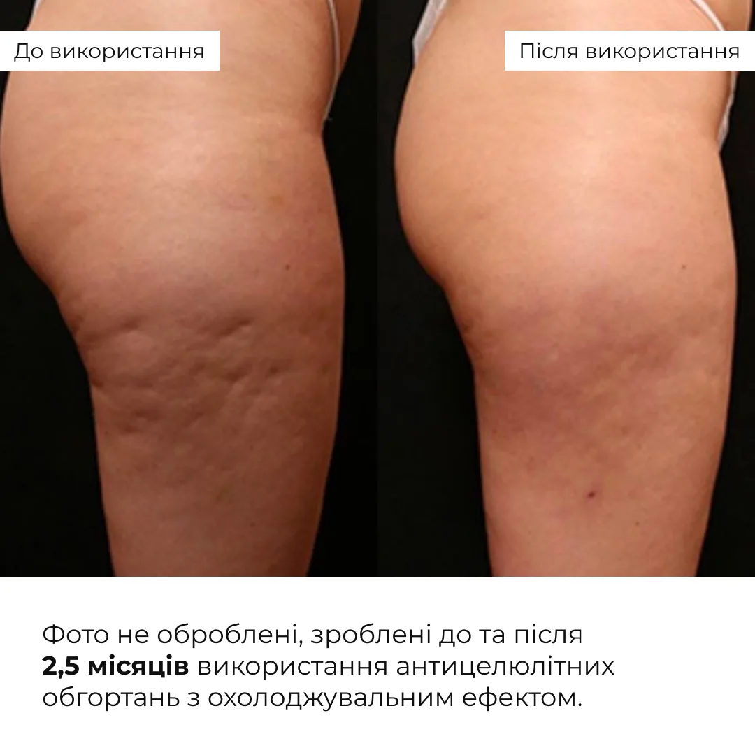 Антицелюлітні обгортання з охолоджувальним ефектом Hillary Anti-cellulite Bandage Cooling Effect
