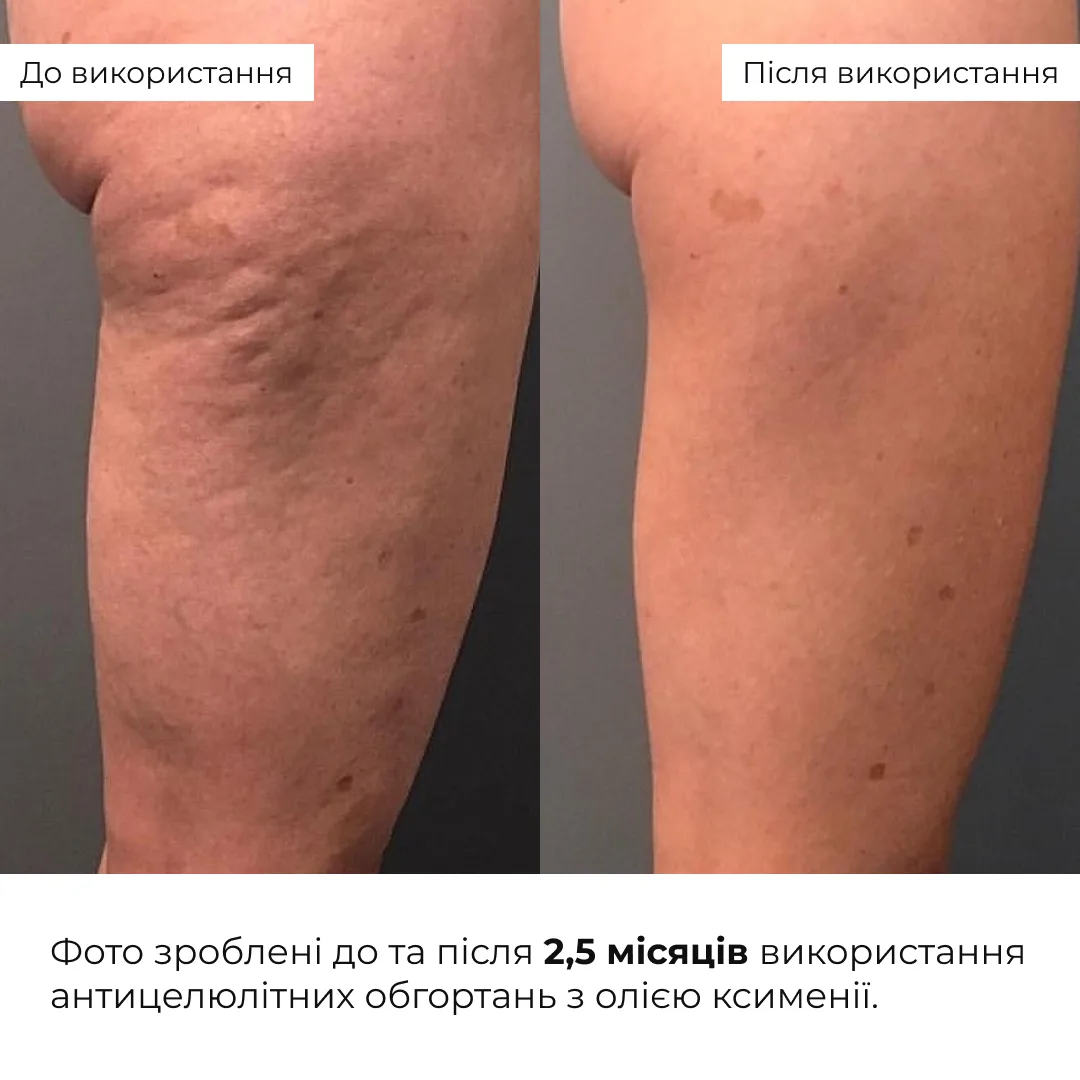 Комплекс Антицелюлітних обгортань з олією ксименії Hillary Anti-cellulite Bandage African Ximenia (10 уп,)