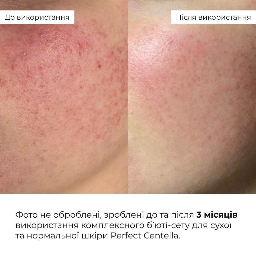 Комплексний б’юті-сет для сухої та нормальної шкіри Hillary Perfect Centella Deep Hydration