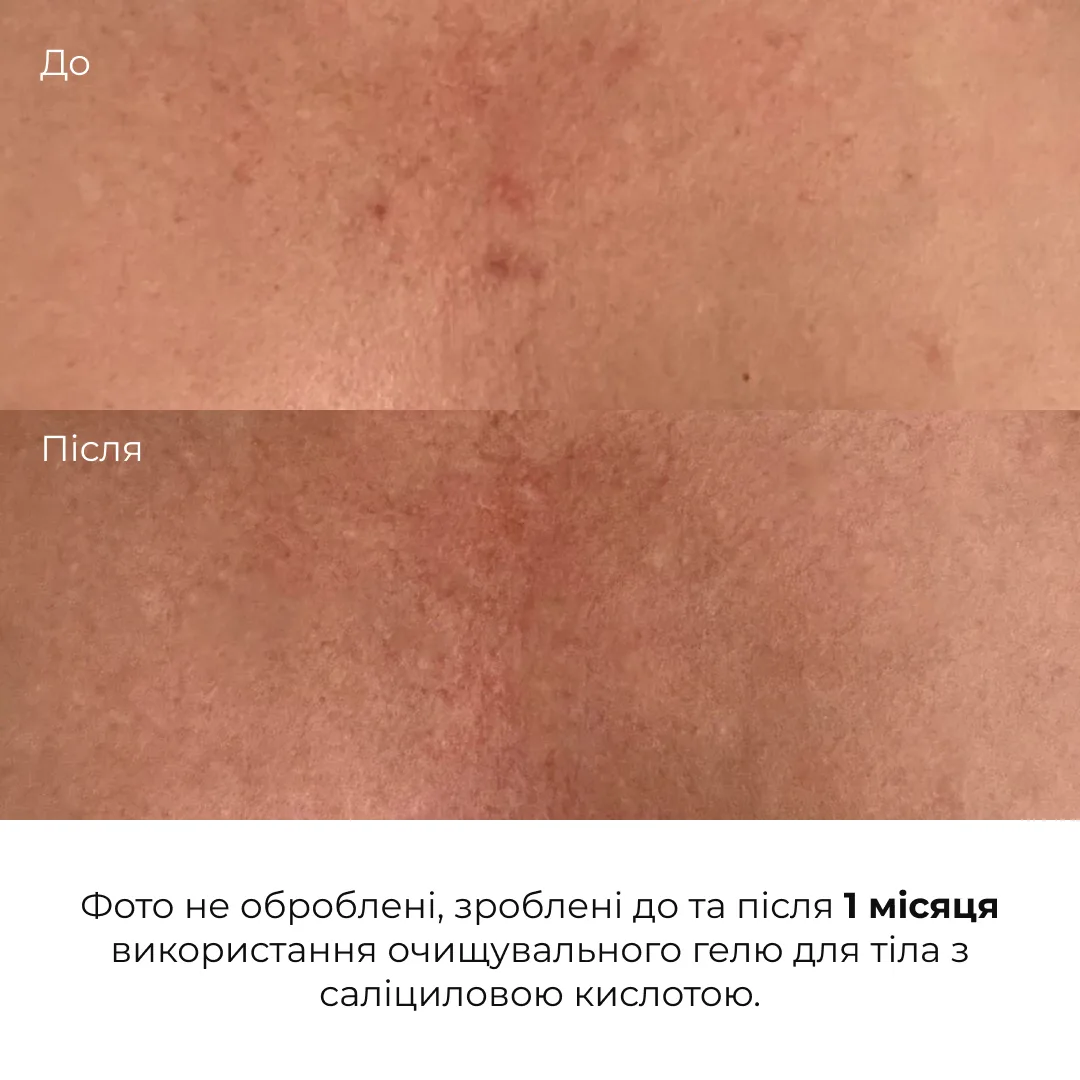 Очищувальний гель для тіла з саліциловою кислотою Hillary Anti-Acne Salicylic Body Wash, 200 мл