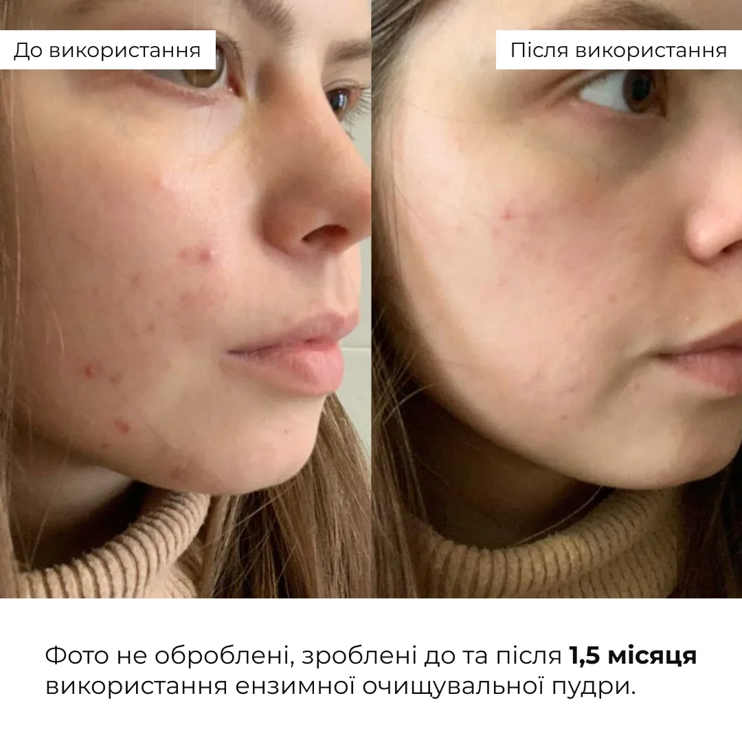 Набір для підлітків із проблемною шкірою Hillary for teenagers with problematic skin