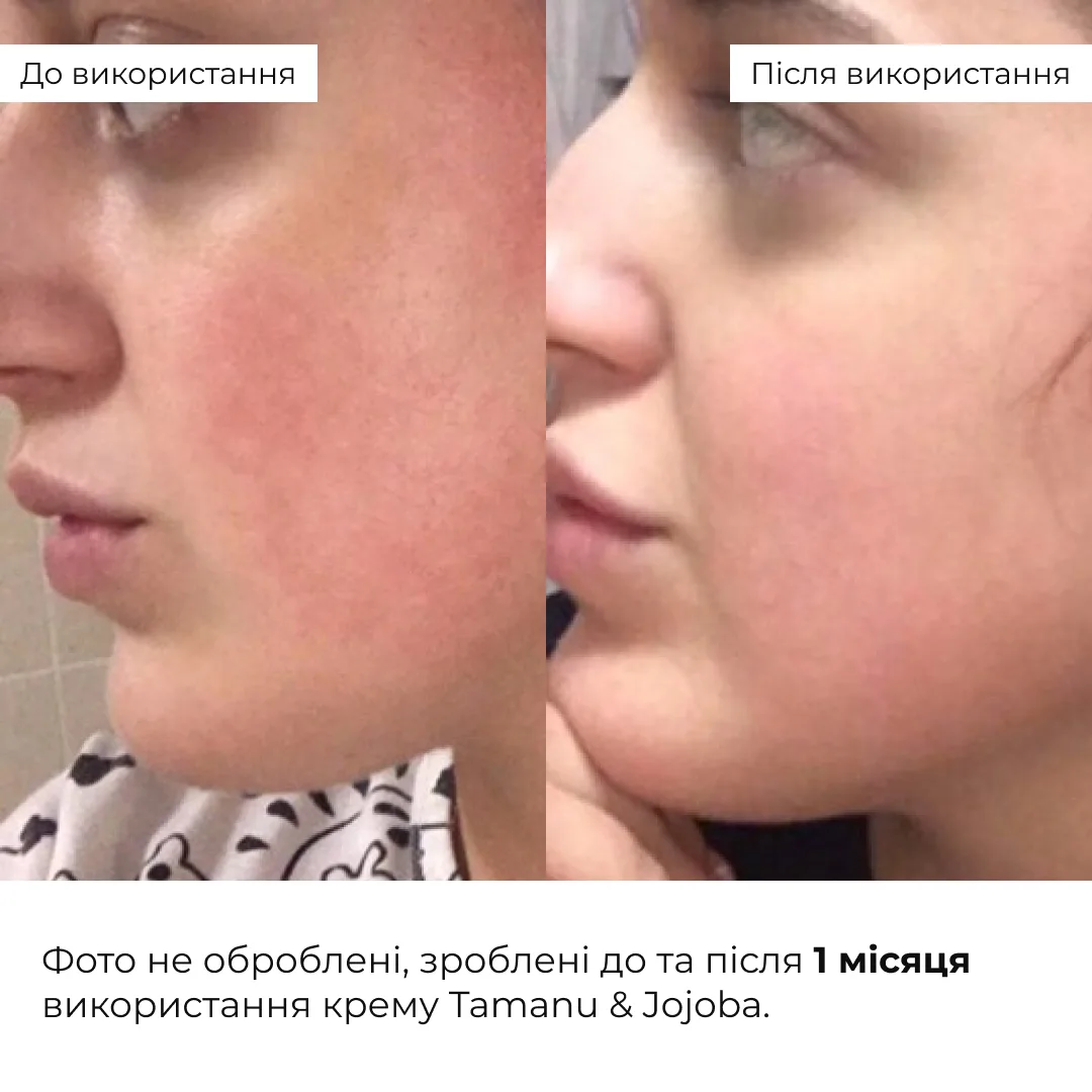 Набір себорегулюючого догляду для жирної та проблемної шкіри обличчя Hillary for oily and problematic skin
