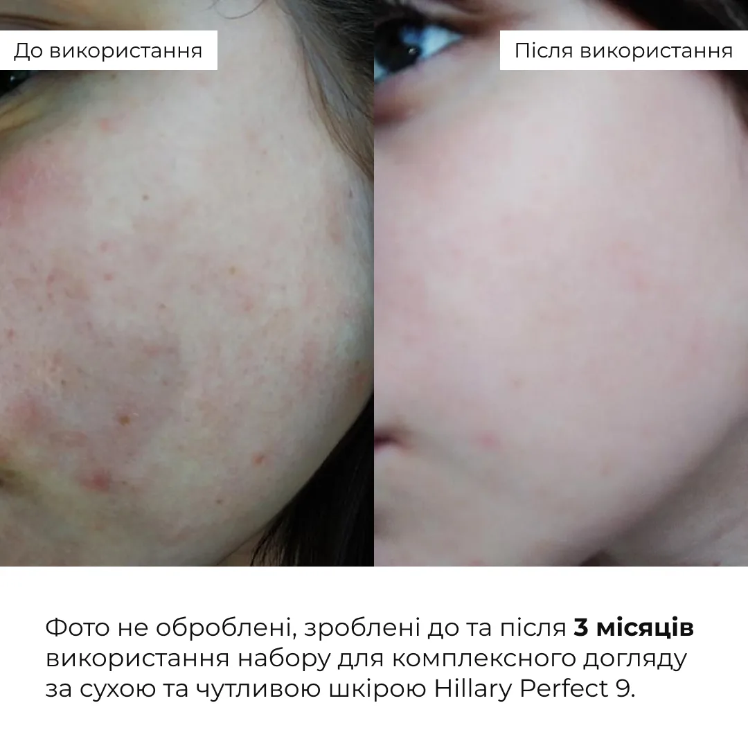 Набір для комплексного догляду за сухою та чутливою шкірою Hillary Perfect 9