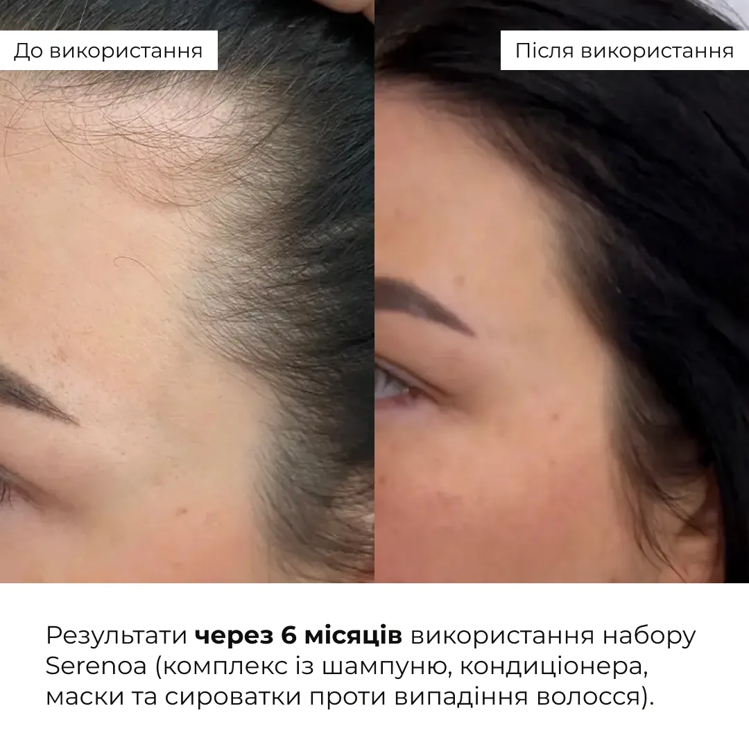 Шампунь проти випадіння волосся Hillary Serenoa & РР Hair Loss Control Shampoo, 250 мл