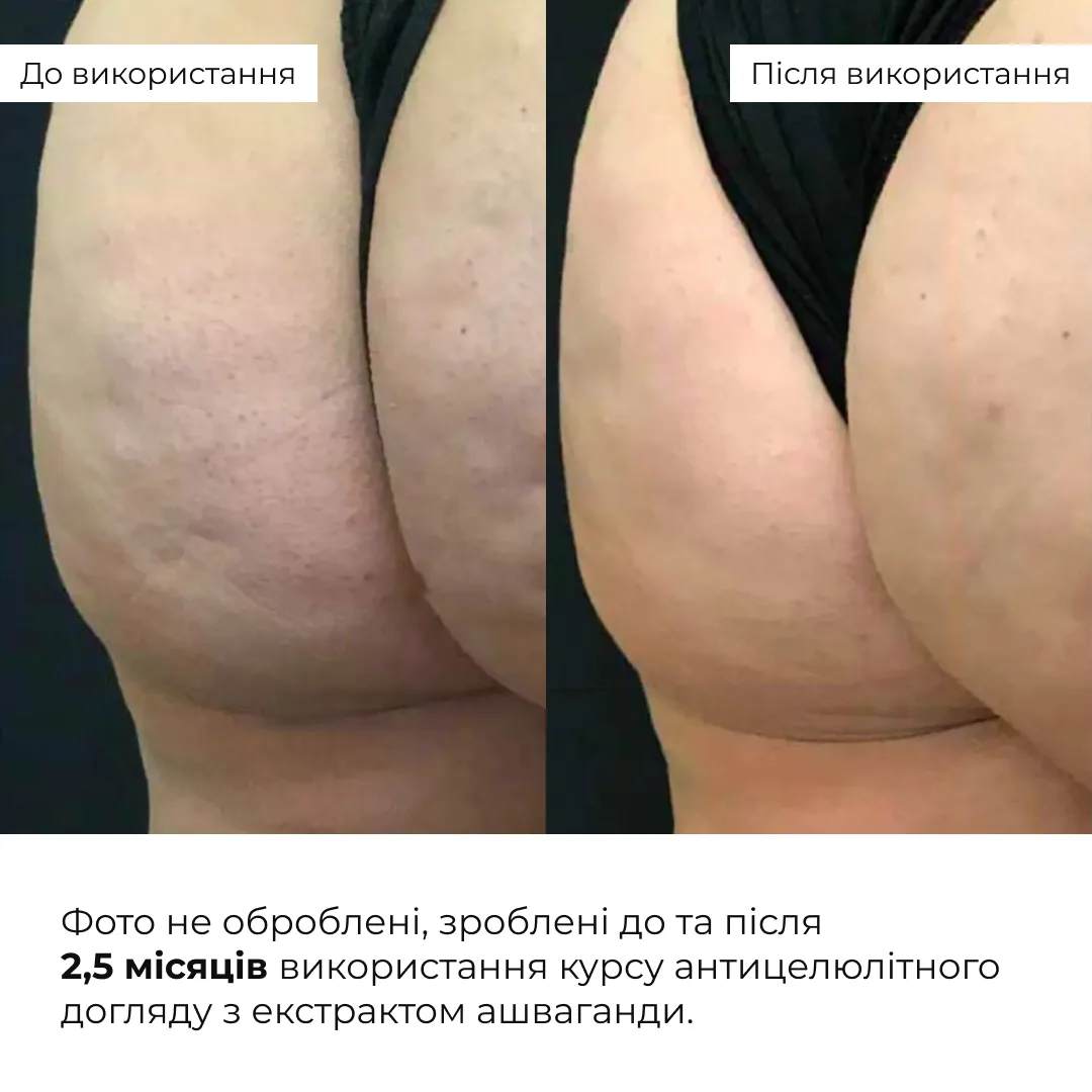 Курс антицелюлітного догляду в домашніх умовах з екстрактом ашваганди Hillary Ashwagandha Anti-Cellulite Care