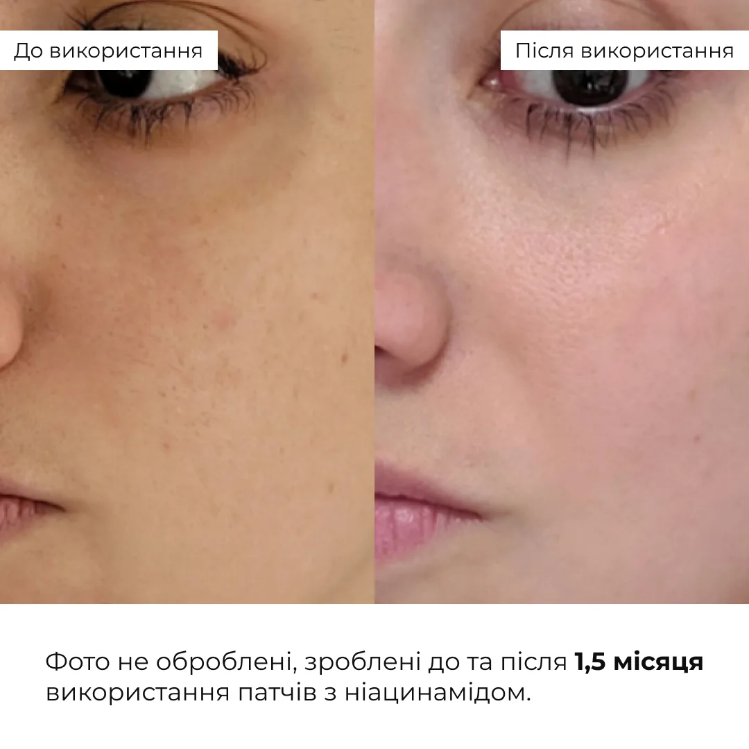 Мультифункціональні та заспокійливі патчі Hillary Niacinamide & Centella