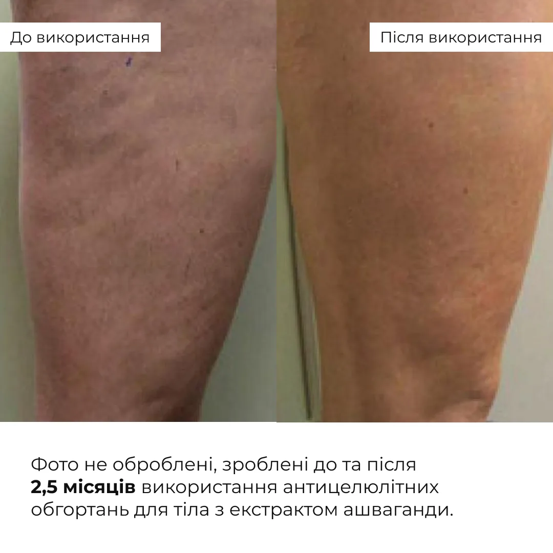 Набір антицелюлітних розігрівальних обгортань Hillary Heating Anti-Cellulite Wrap Set