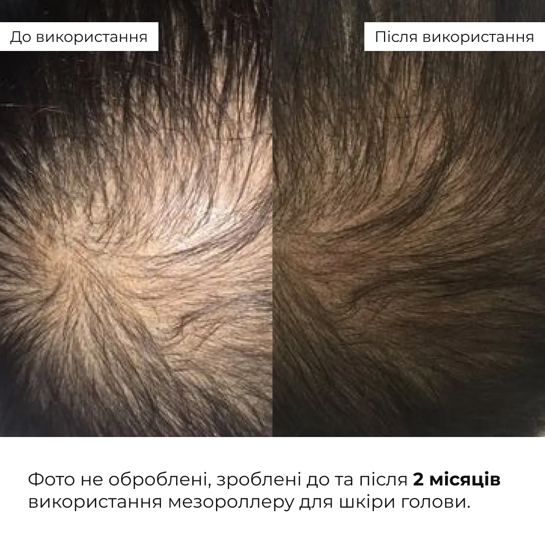 Мезороллер для кожи головы Hillary с сывороткой MULTI-ACTIVE HOP CONES для роста волос и укрепления фолликулов.