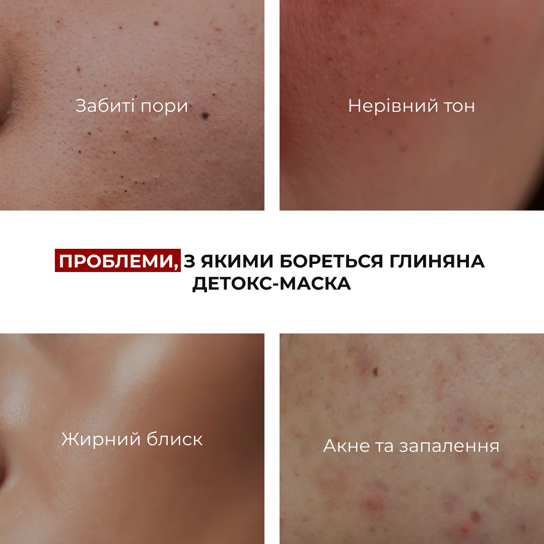 Набір проти висипань, набряків і тьмяних губ Hillary Anti-Acne, Anti-Puffiness & Lip Glow Set