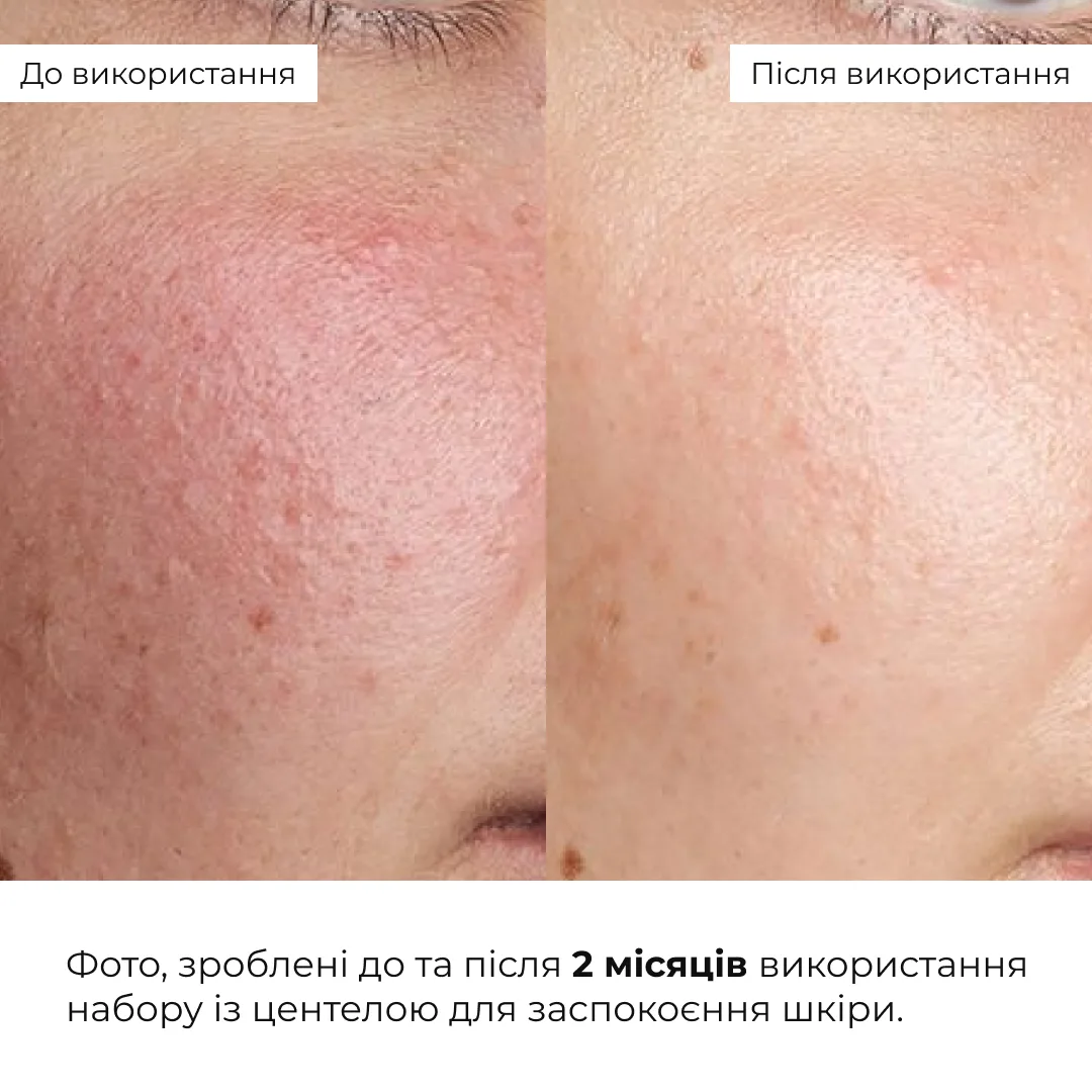 Набор для ухода за чувствительной кожей Hillary Centella Soothing Recovery Set с центеллой для восстановления кожи и успокоения кожи.