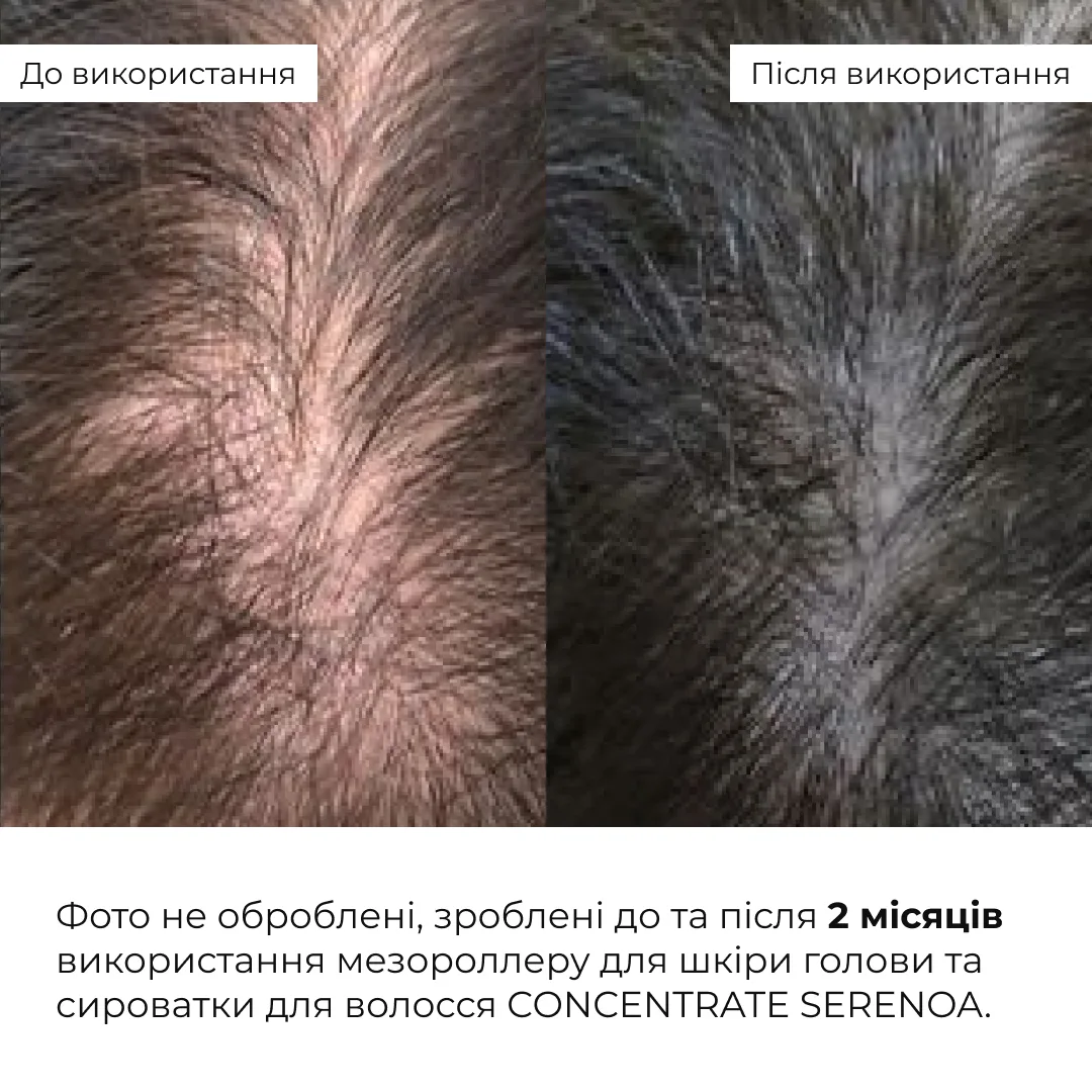Мезороллер для шкіри голови Hillary + Сироватка для волосся CONСENTRATE SERENOA
