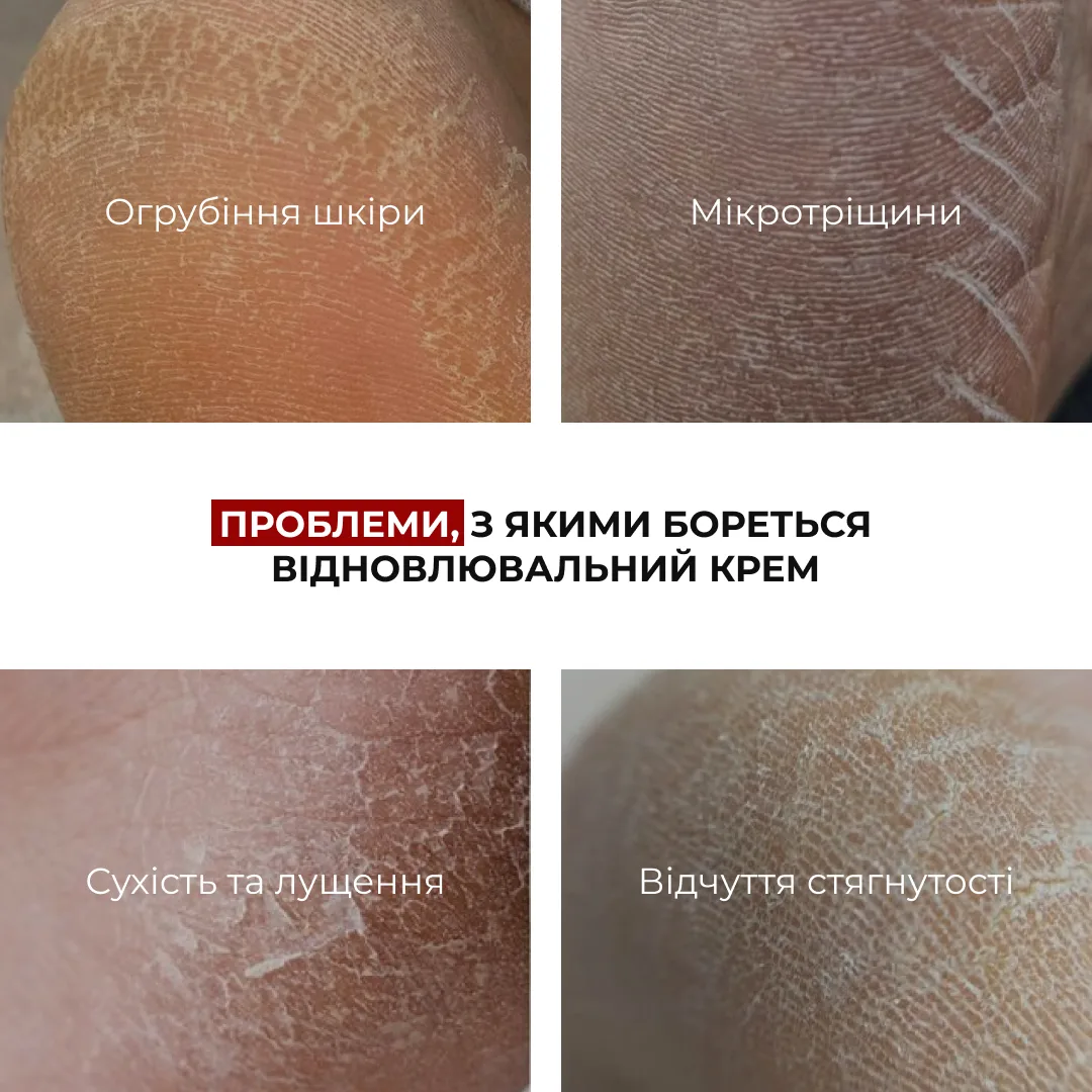 Набір для відновлення потрісканих п’ят Hillary Cracked Heel Repair Complex
