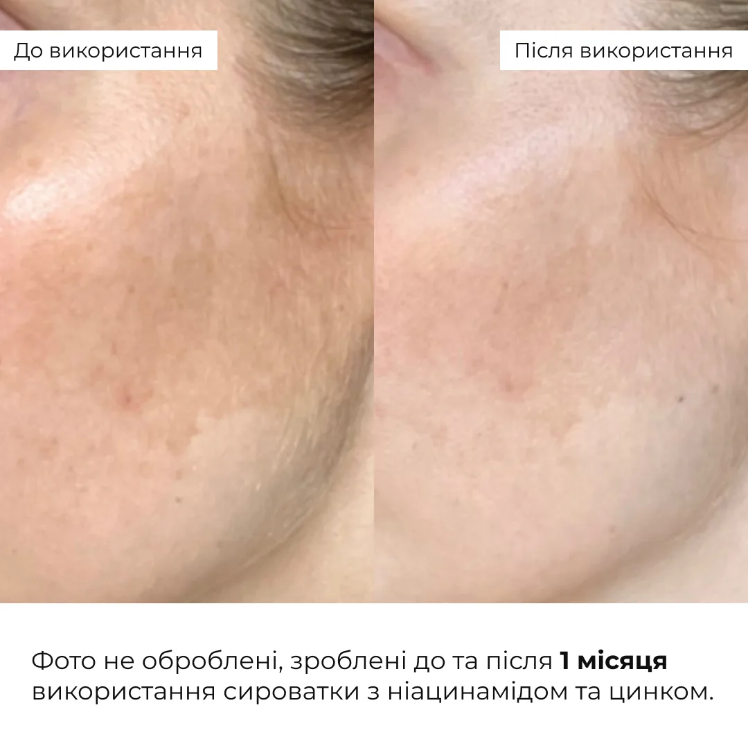 Комплекс для восстановления тонуса и защиты от пигментации SPF 30 Hillary набор для лица увлажнение защита от солнца