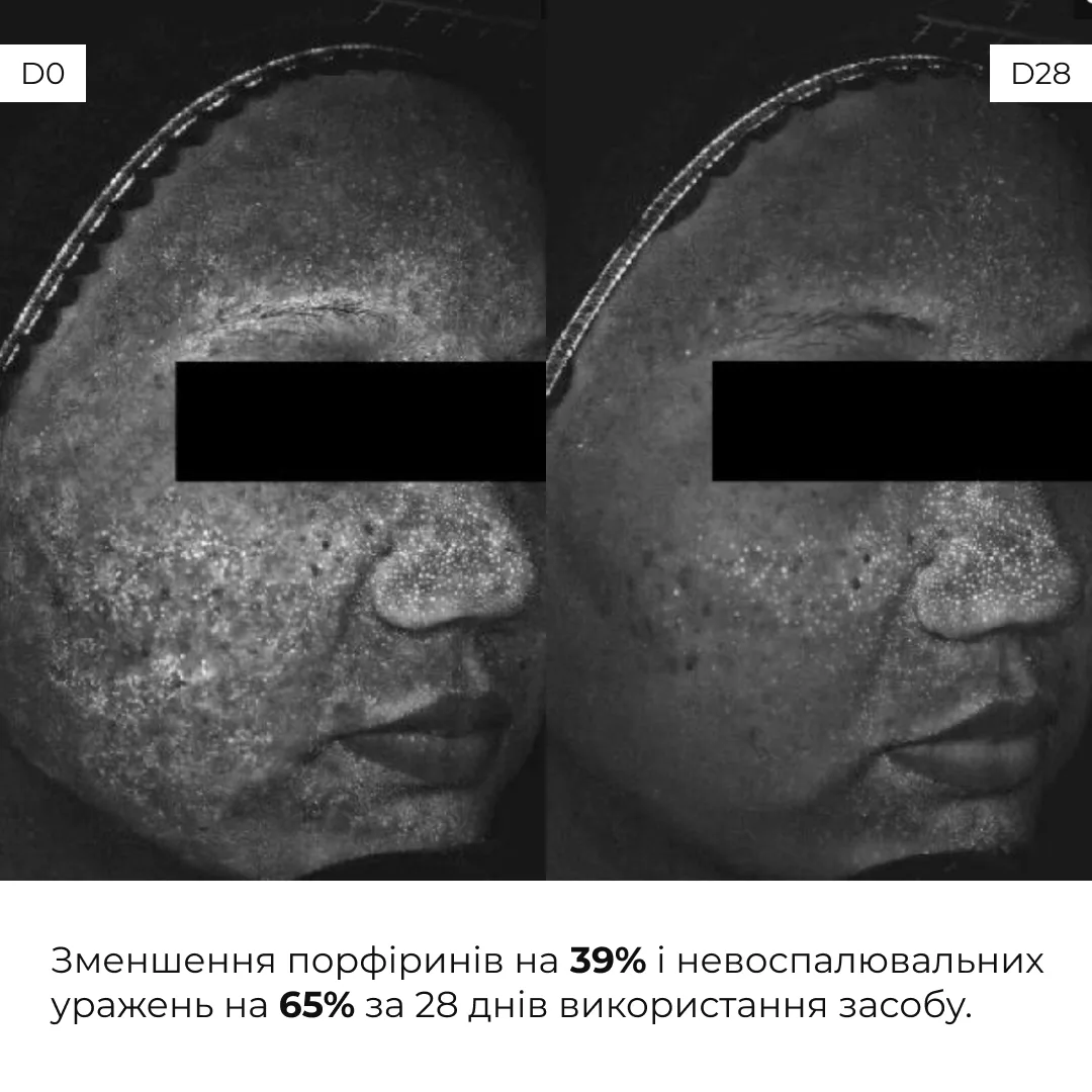 Весенний уход для жирной кожи Hillary набор для очищения, увлажнения и нормализации pH.