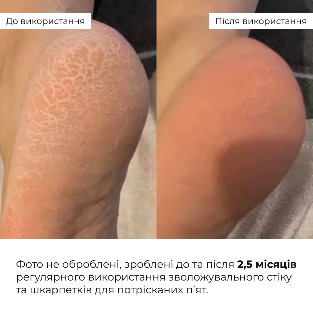 Зволожувальний стік для потрісканих п’ят із ефірною олією чайного дерева Hillary HydraHeel Soft Stick Tea Tree