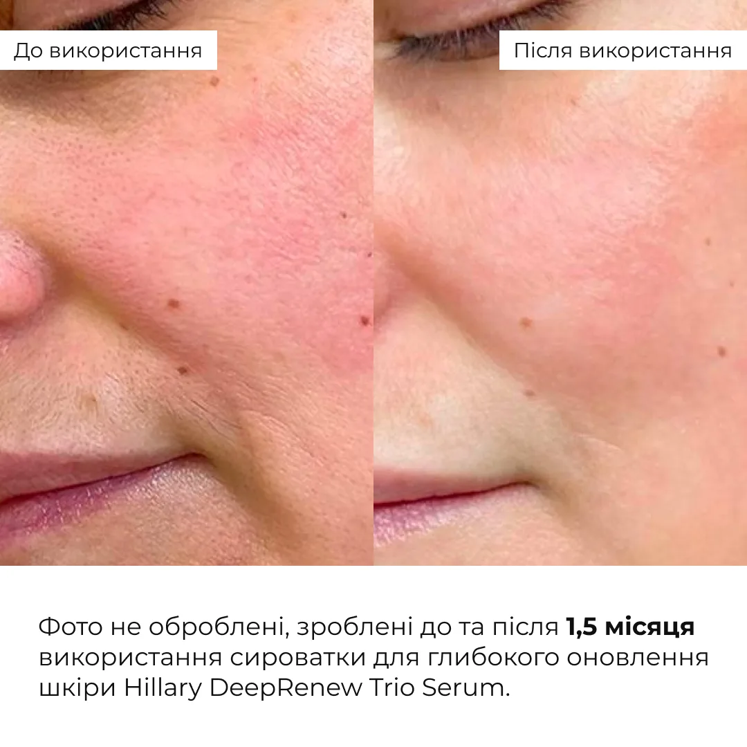 Сироватка для глибокого оновлення шкіри Hillary DeepRenew Trio Serum, 30 мл