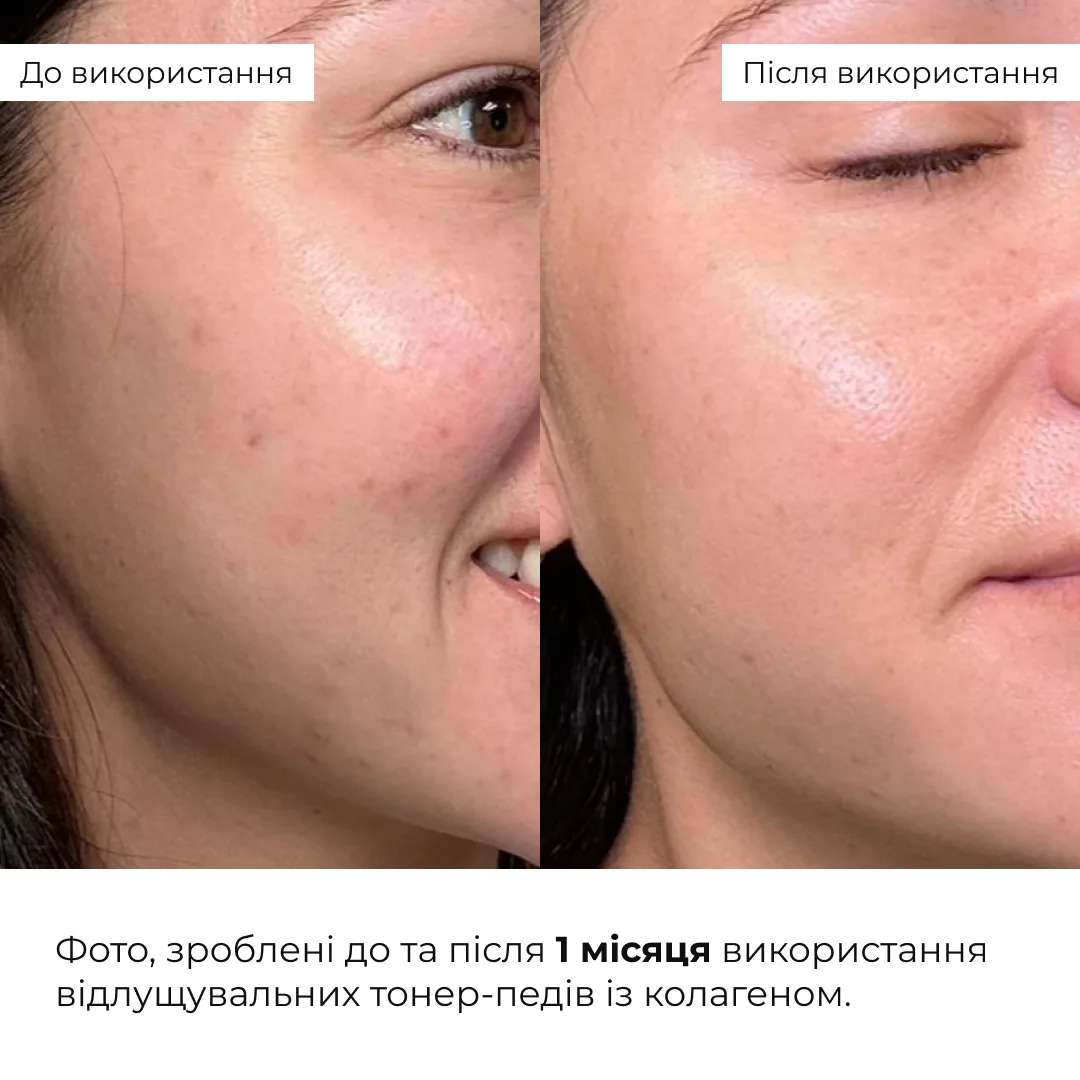 Комплекс интенсивного обновления и себорегуляции Hillary для жирной кожи снимает воспаление и контролирует себум.