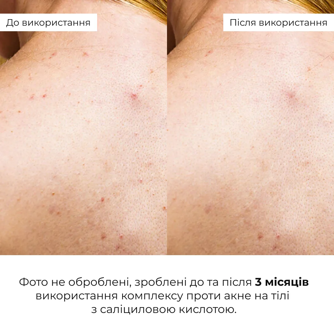 Набір проти запалень і висипань на тілі Hillary Back & Body Acne Care Set