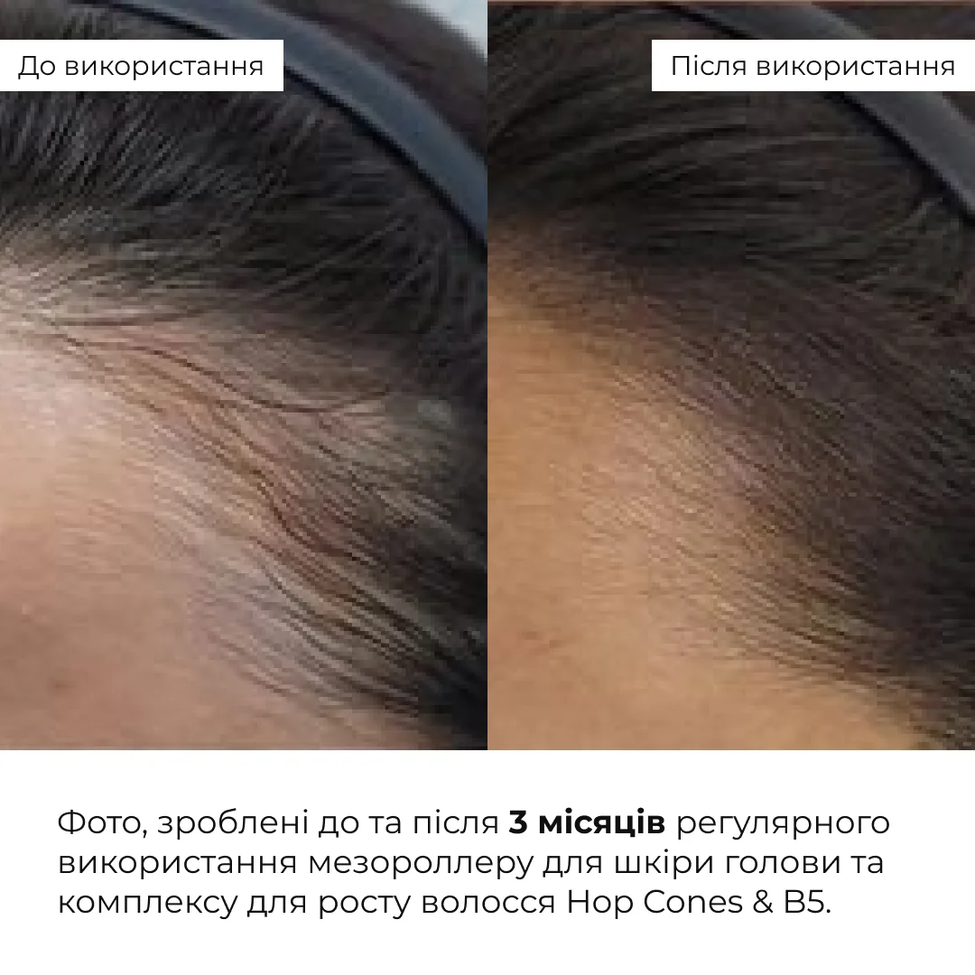 Мезороллер для шкіри голови + Комплекс для росту волосся Hop Cones & B5 Hair Growth Invigorating