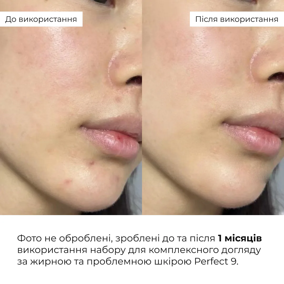 Набір для комплексного догляду за жирною та проблемною шкірою Hillary Perfect 9