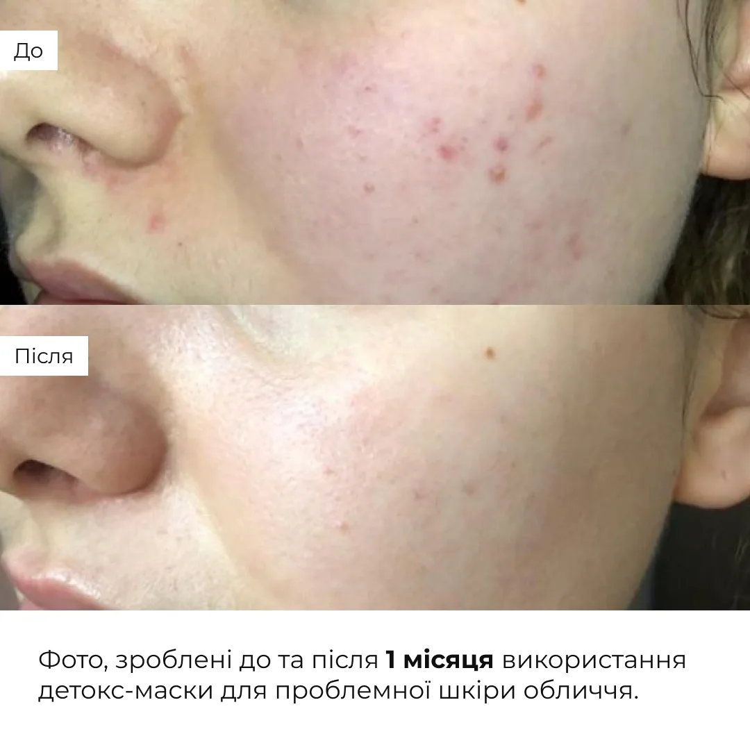 Набір інтенсивного догляду проти висипань та жирного блиску Hillary Intensive Anti-Blemish & Oil Control Set