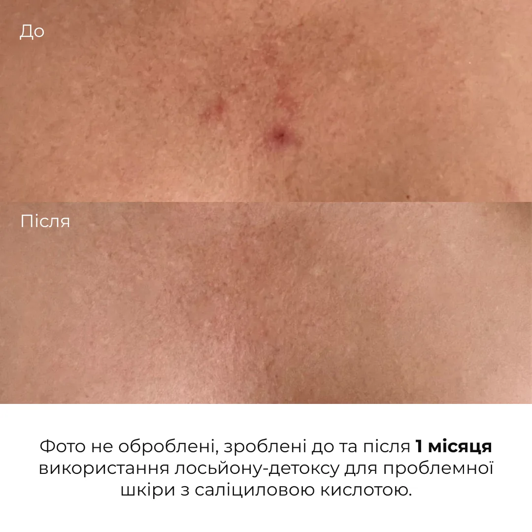 Лосьйон-детокс для проблемної шкіри з саліциловою кислотою Hillary Anti-Acne Salicylic Body Lotion, 150 мл