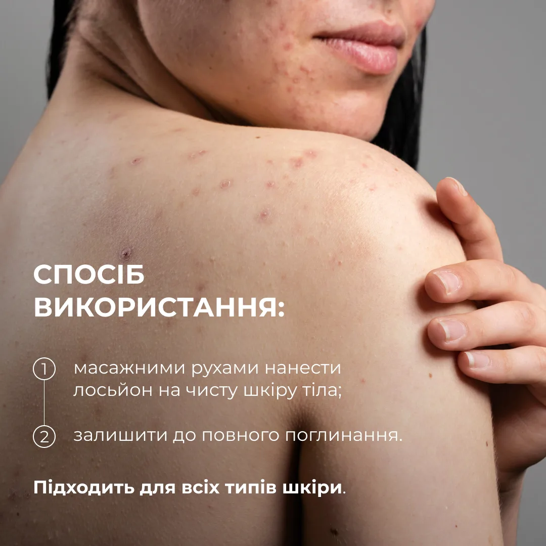 Лосьйон-детокс для проблемної шкіри з саліциловою кислотою Hillary Anti-Acne Salicylic Body Lotion, 150 мл