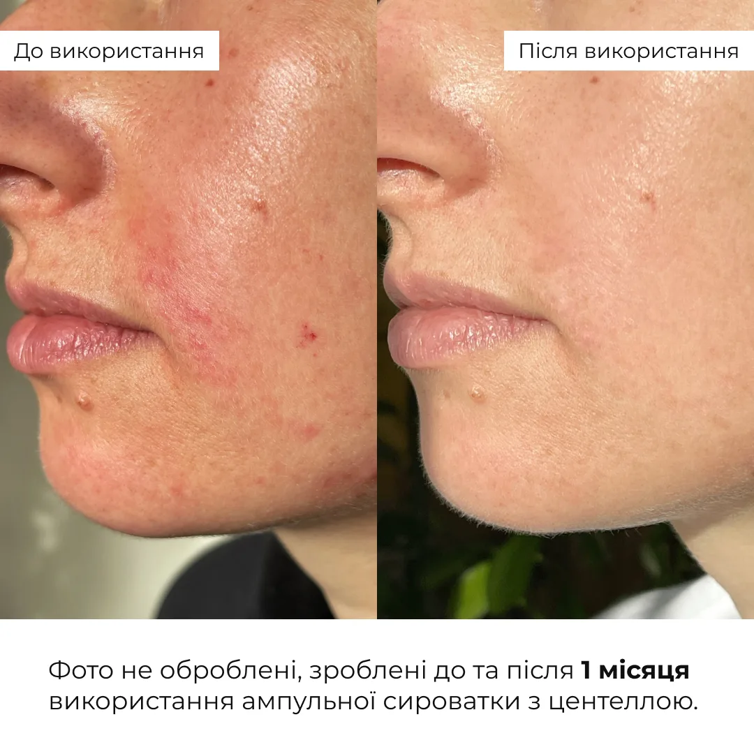 Набір для відновлення та освітлення чутливої шкіри Hillary Sensitive Skin Recovery & Glow Set