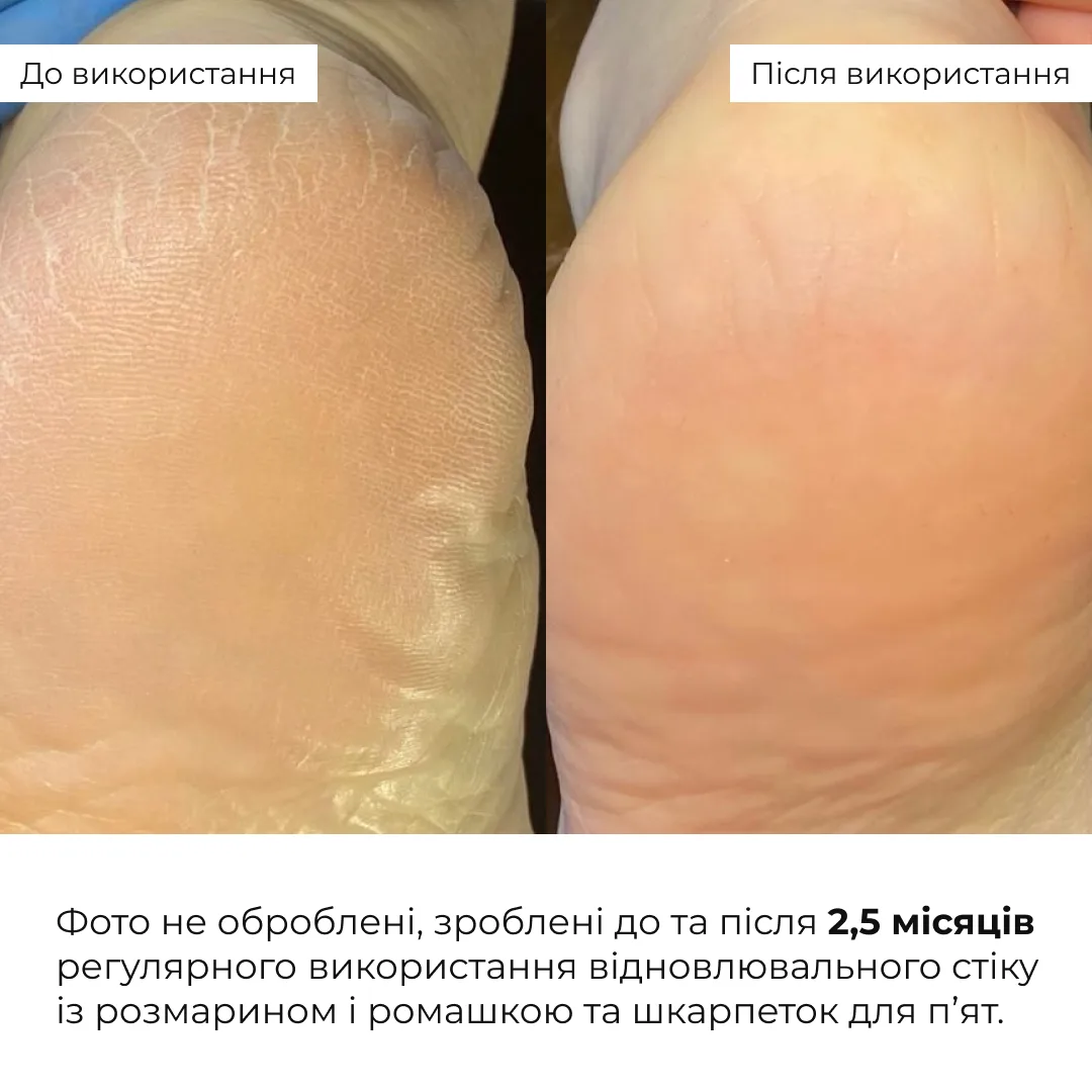 Комплекс для загоєння тріщин та пом’якшення п’ят Hillary Cracked Heel Repair & Softening Complex