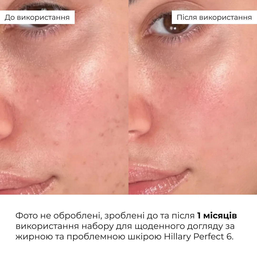 Набір для щоденного догляду за жирною та проблемною шкірою Hillary Perfect 6