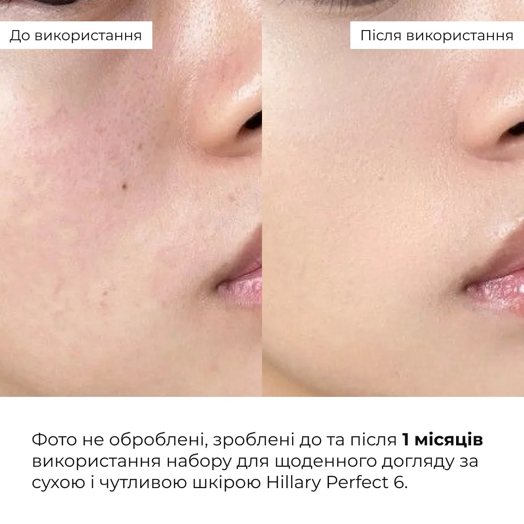 Набор для ежедневного ухода за сухой и чувствительной кожей Hillary Perfect 6 для увлажнения и восстановления гидролипидного барьера.